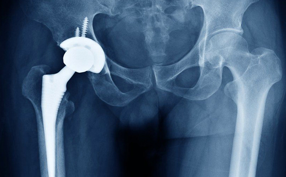 Dr. Ankit Agrawal Best Orthopaedic Surgeon, Best Orthopaedic Surgeon in Mathura, best doctor Dr. Ankit Agrawal in Mathura,orthopedic doctor in mathura, hip replacement in mathura, best doctor in mathura , Best Orthopaedic Surgeon in Mathura, knee replacement in mathura, best doctor Dr. Ankit Agrawal in Mathura